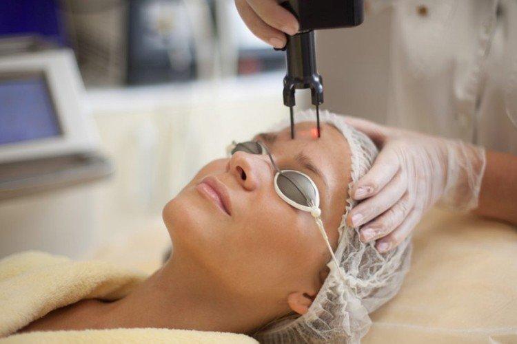 Peeling laser du visage