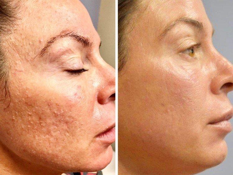 Peeling du visage - photos avant et après