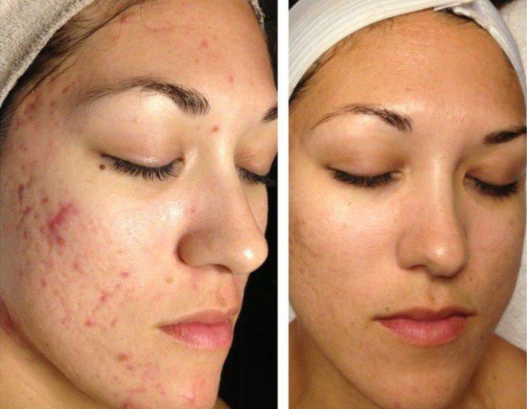 Peeling du visage - photos avant et après