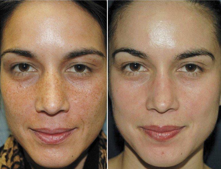 Peeling du visage - photos avant et après