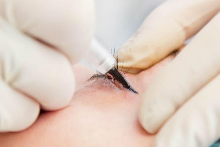 Ai-je besoin d'une correction de tatouage des yeux ?