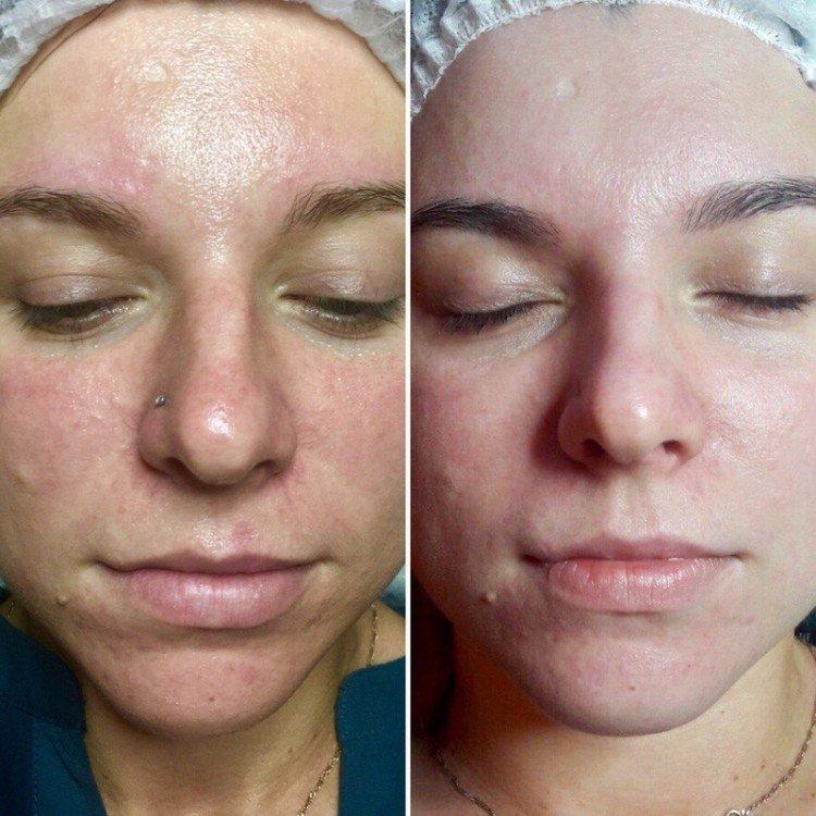 Nettoyage du visage par ultrasons - photos avant et après